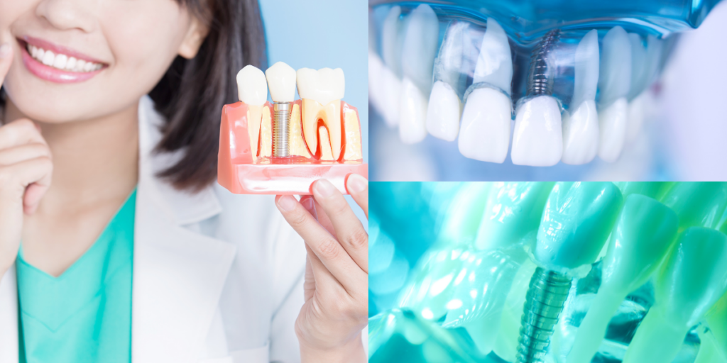 Dental office 63304, replacing missing teeth with dental implants, restoring functionality and enhancing the patient’s smile.